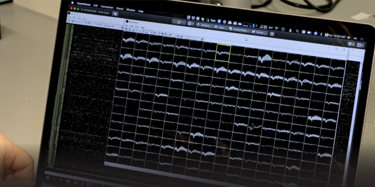 Uomo paralizzato chiede birra col pensiero grazie a un innesto cerebrale